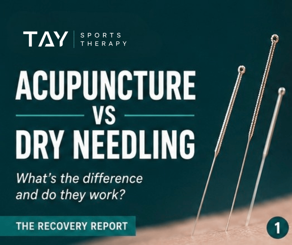 ACUPUNCTURE VS DRY NEEDLING: WHAT’S THE&nbsp;DIFFERENCE?